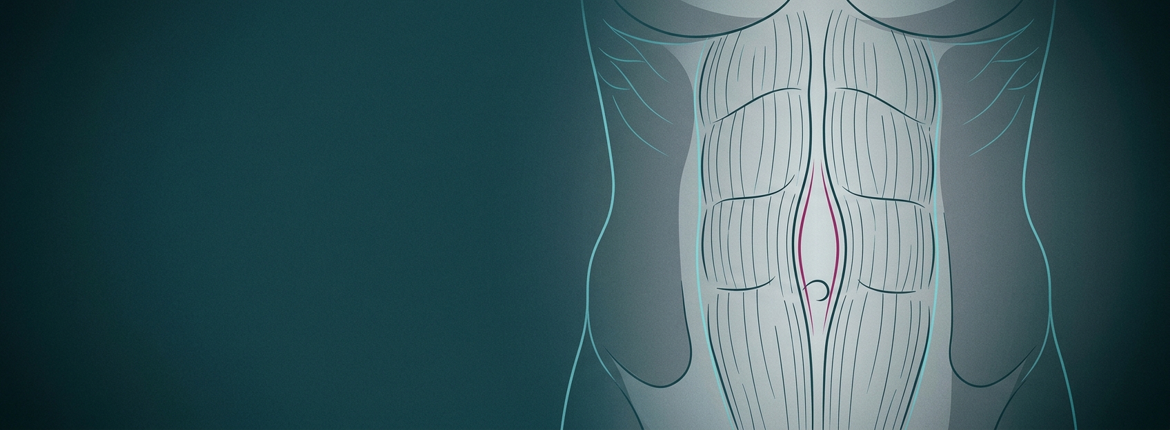 The two rectus abdominis muscles separated by a widened linea alba