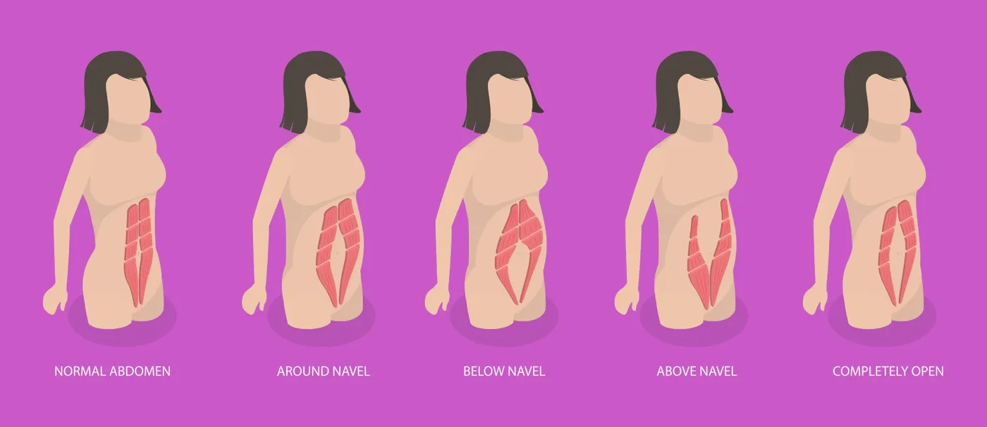 Diagram of where diastasis recti can occur: normal abdomen, around the navel, below the navel, above the navel and along the whole midline
