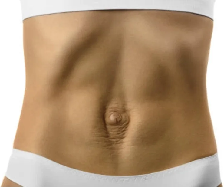 Female abdomen at rest with a protruding navel and a slight bulge along the midline