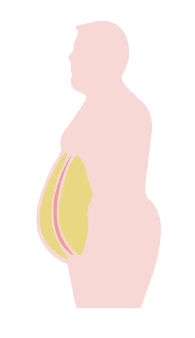 Visceral fat deep around the organs raising intra-abdominal pressure