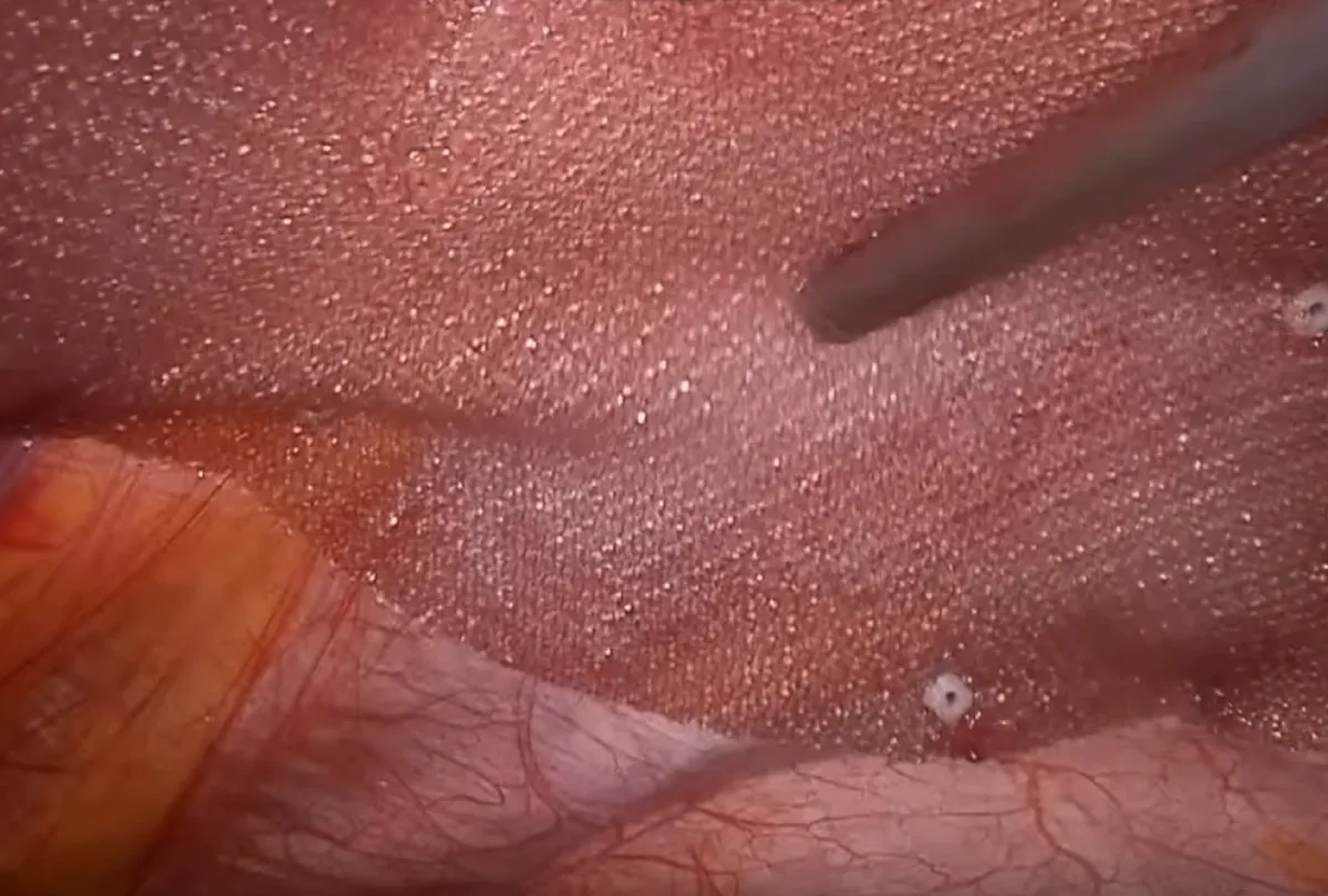 Posterior intraperitoneal approach with intraperitoneal mesh