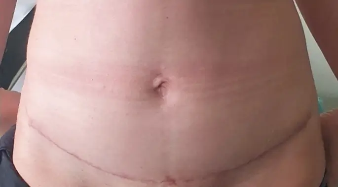 Laparoplasty with mini-abdominoplasty scar pattern