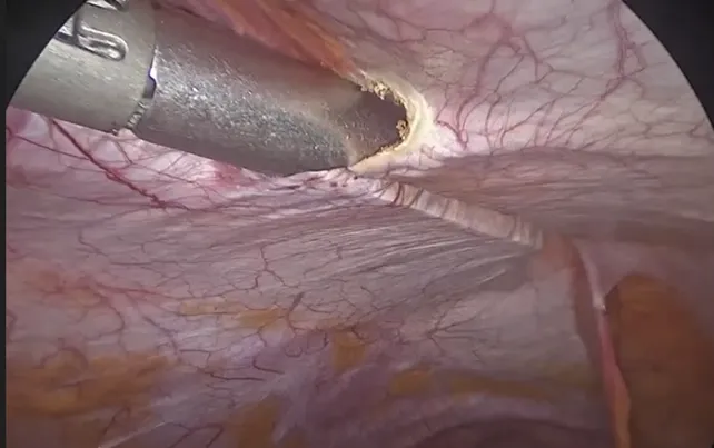 MISAR stapled abdominal reconstruction technique