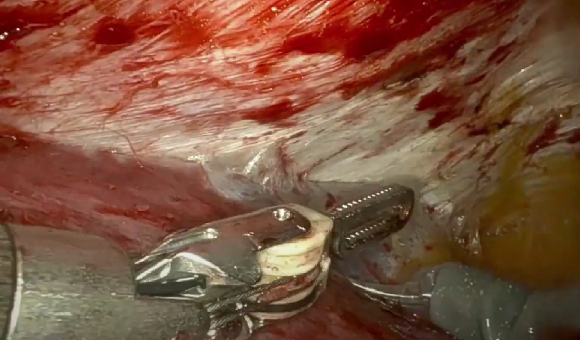 PeTEP preperitoneal enhanced-view totally extraperitoneal approach
