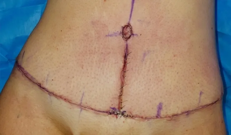 Why some cases result in an inverted-T scar and others a horizontal scar