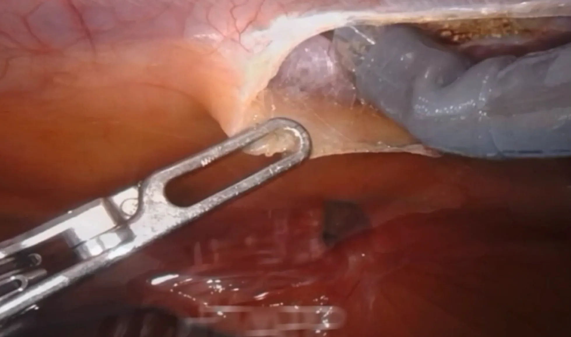 TAPP technique creating a preperitoneal plane for the mesh