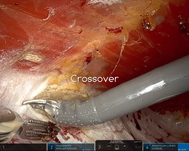 eTEP extraperitoneal endoscopic repair of the midline