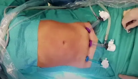 TESAR technique schematic from the abdominal wall surgery atlas