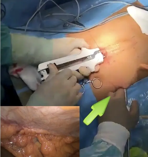 THT stapler technique for midline reconstruction