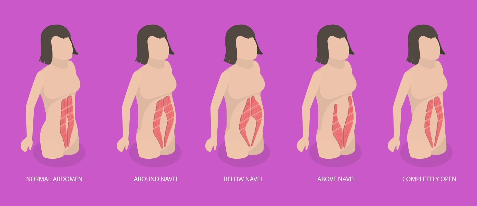 Illustration of diastasis recti with the two rectus muscles separated