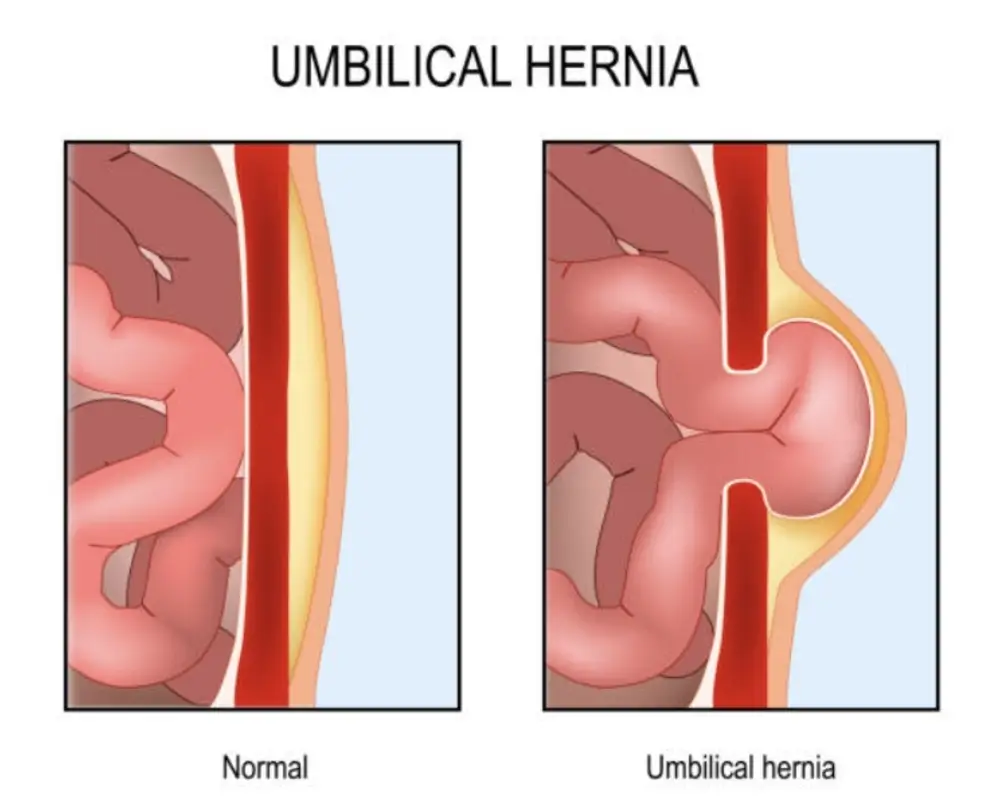 Umbilical hernia: tissue protruding through a defect at the navel